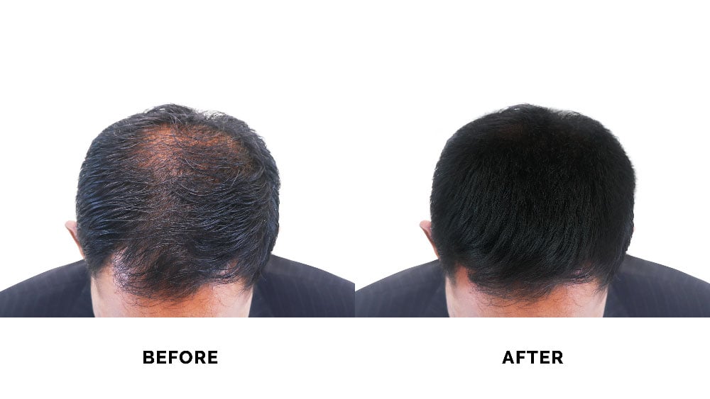 Hair Transplants: Procedure, Costs and Before and After - KeraHealth USA