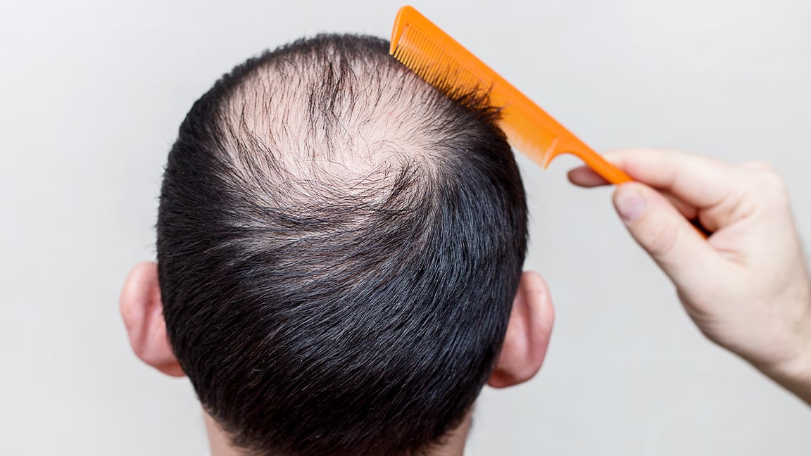 How to Regrow Hair on a Bald Spot - KeraHealth
