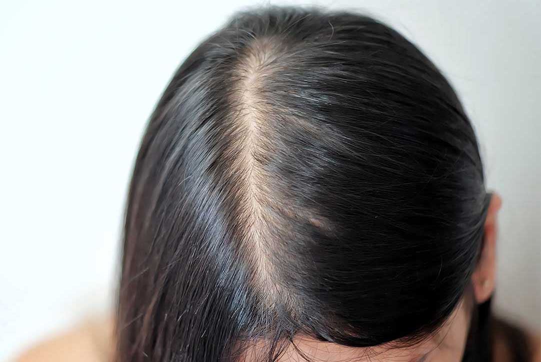Scalp Health: 9 Tips to Reduce Hair Loss and Dandruff - KeraHealth
