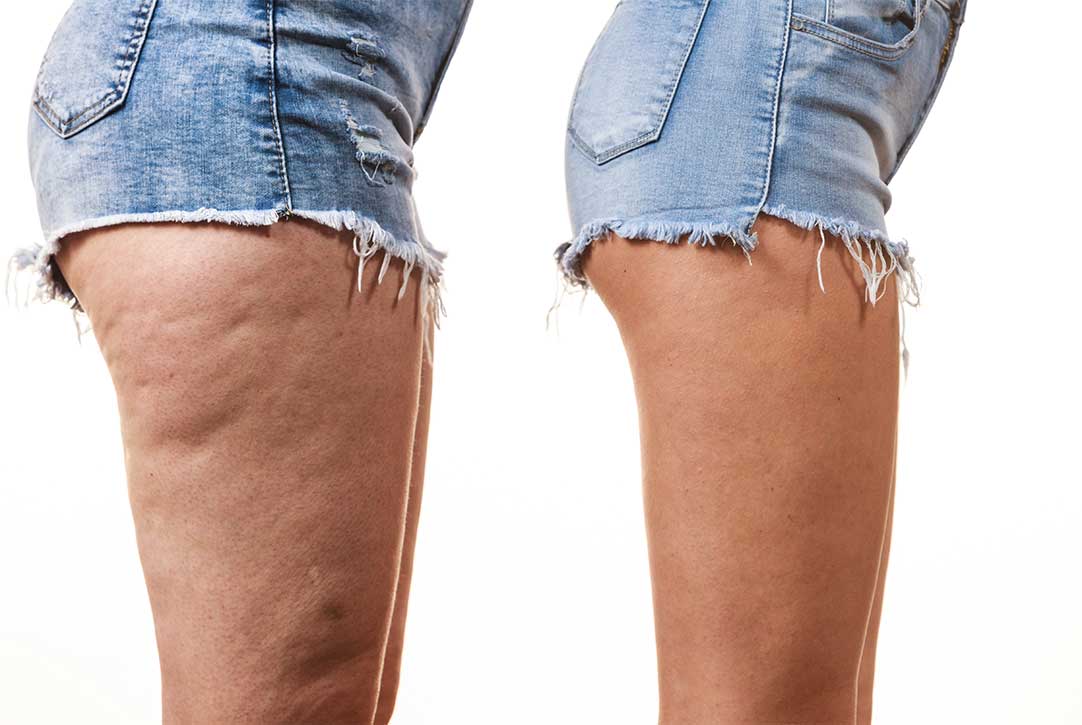 With and without cellulite