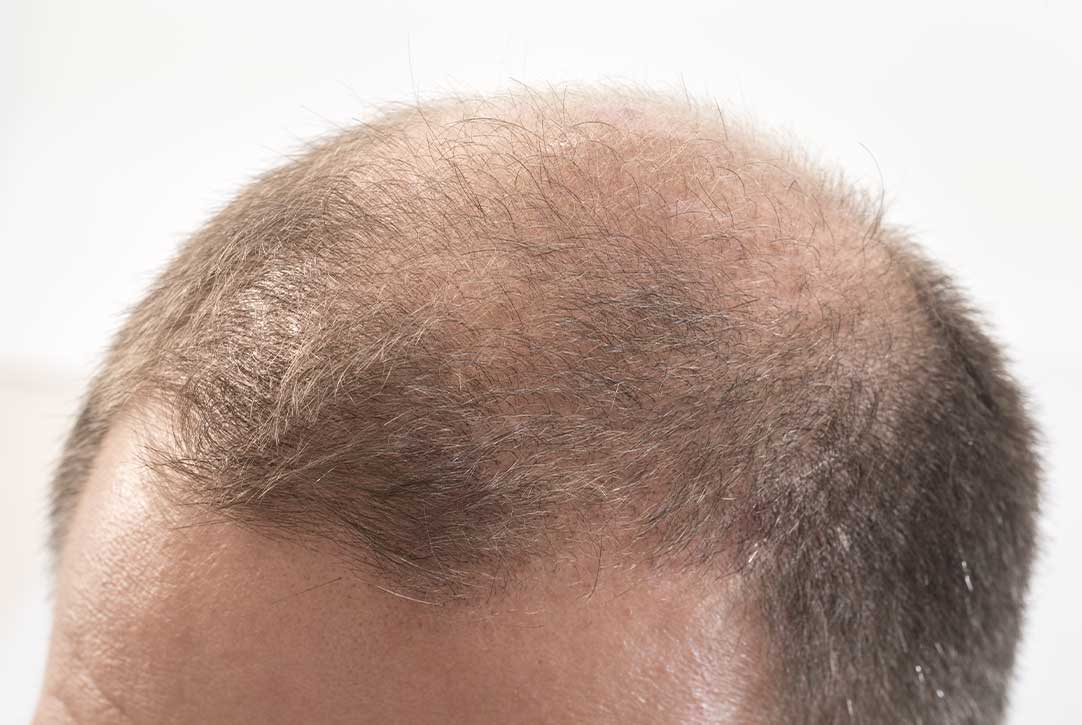 Early Signs of Balding and How to Stop it - KeraHealth Mexico